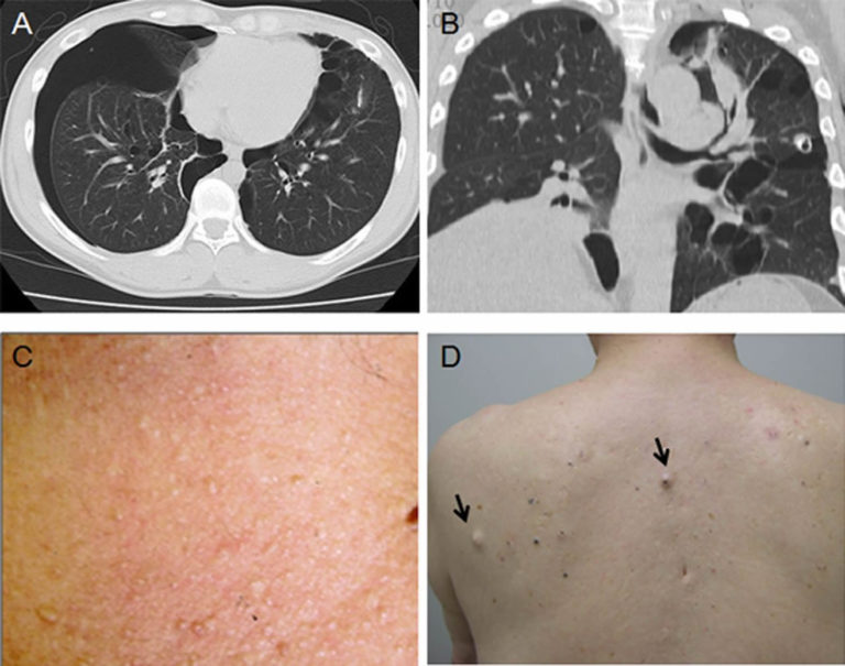 Birt-Hogg-Dube syndrome causes, symptoms, diagnosis & treatment