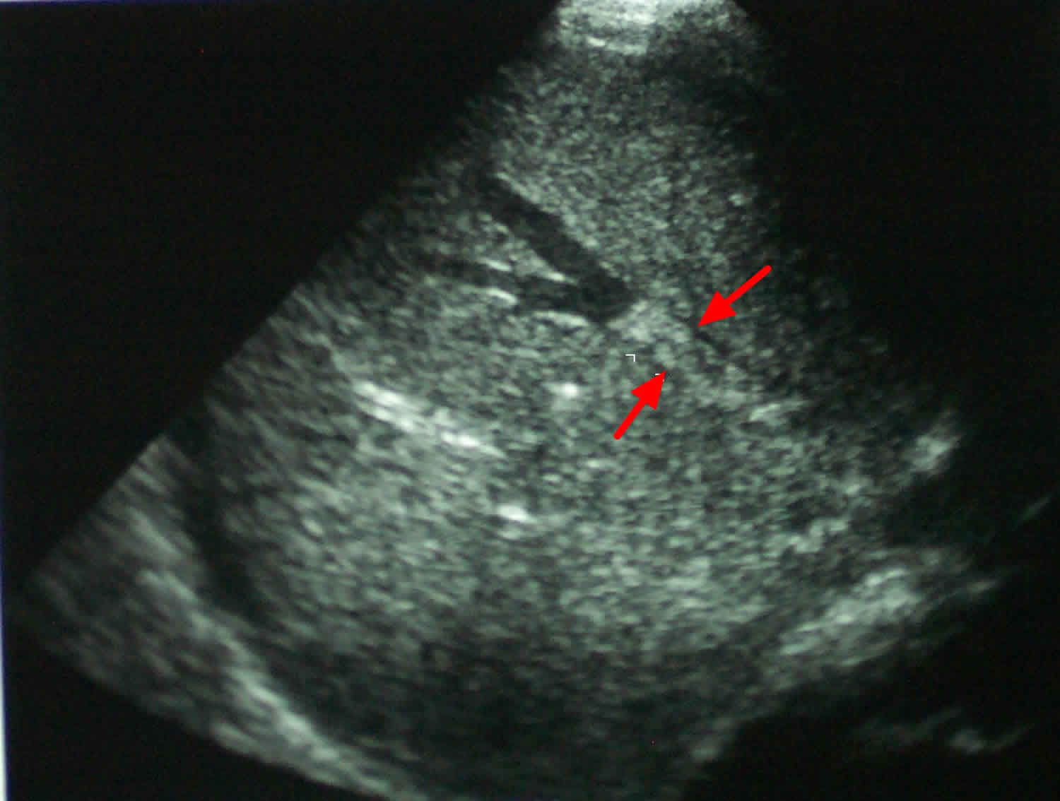 Budd Chiari syndrome ultrasound