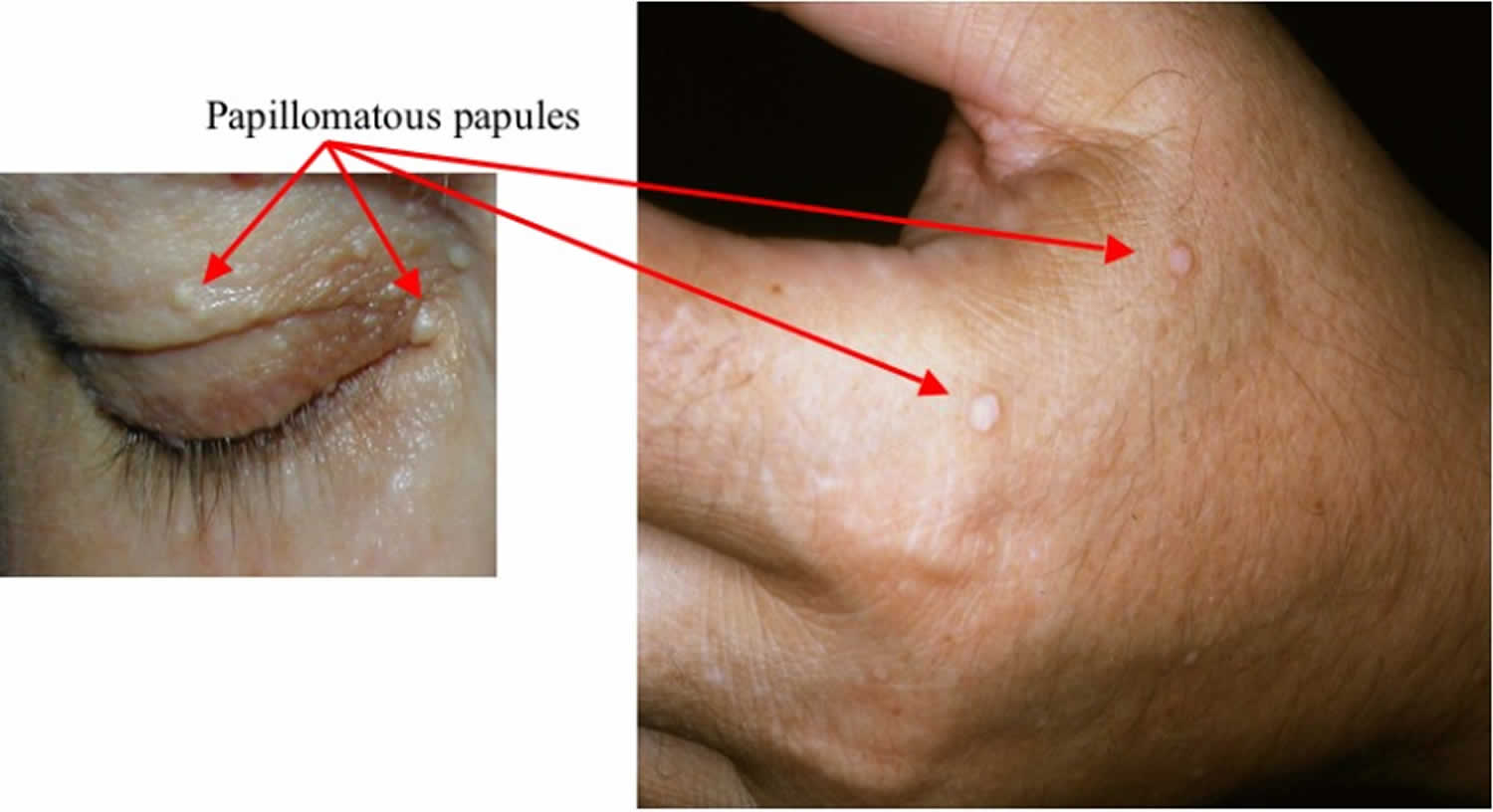 Cowden Syndrome Causes Symptoms Diagnosis Treatment And Prognosis 2088