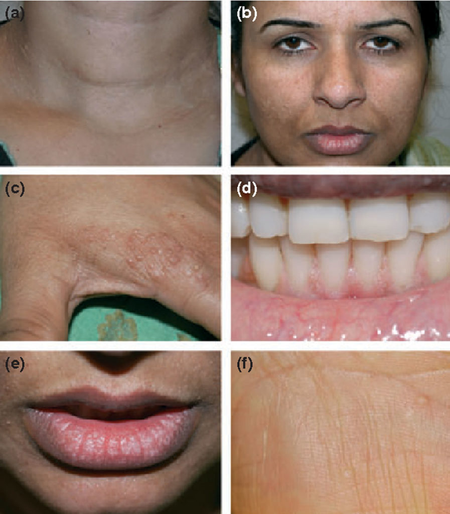 Cowden syndrome causes, symptoms, diagnosis, treatment & prognosis