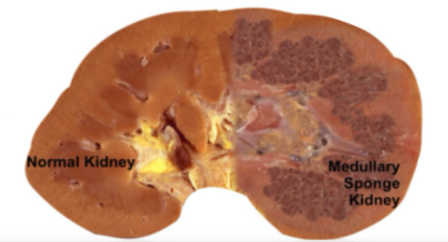 Medullary Sponge Kidney Disease Causes Symptoms Diagnosis Treatment 