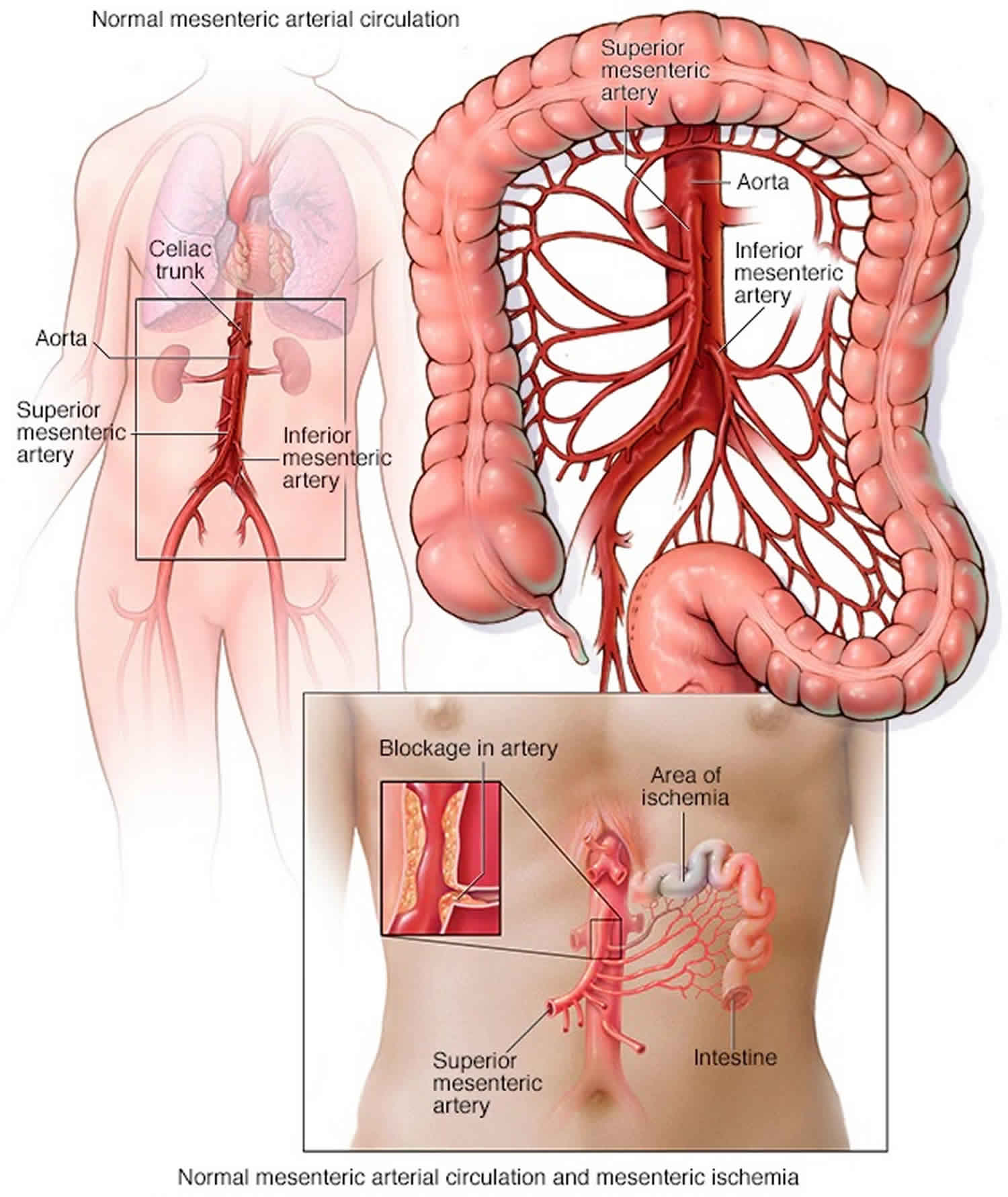 mesenteric-ischemia-causes-symptoms-diagnosis-treatment-prognosis