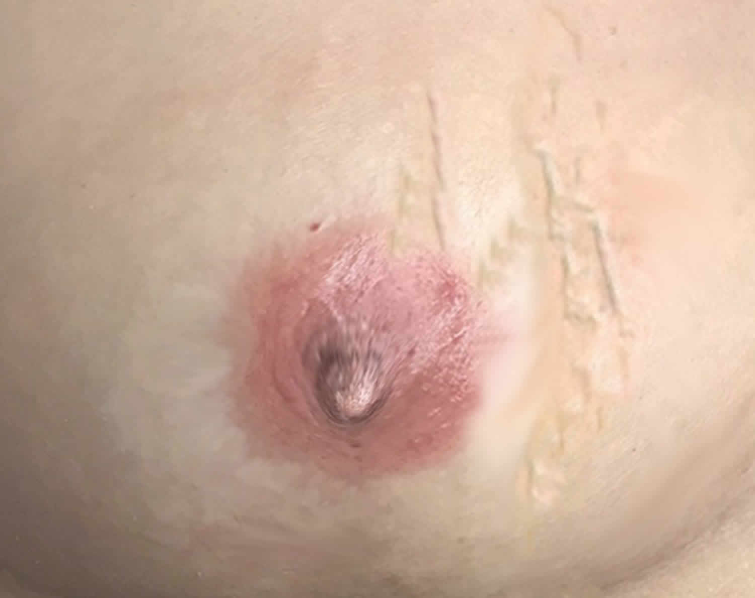 Mondor's disease breast