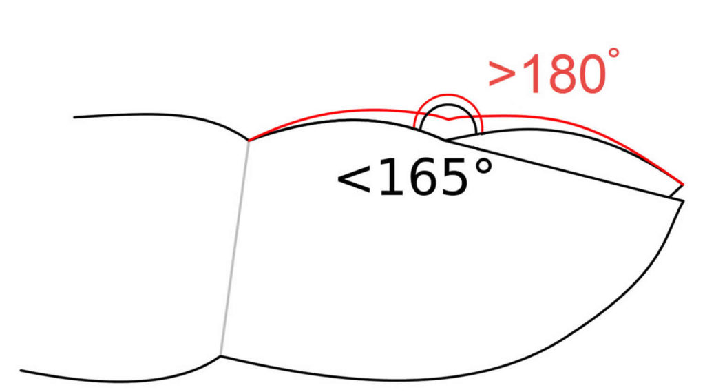 Nail clubbing causes, symptoms & nail clubbing treatment