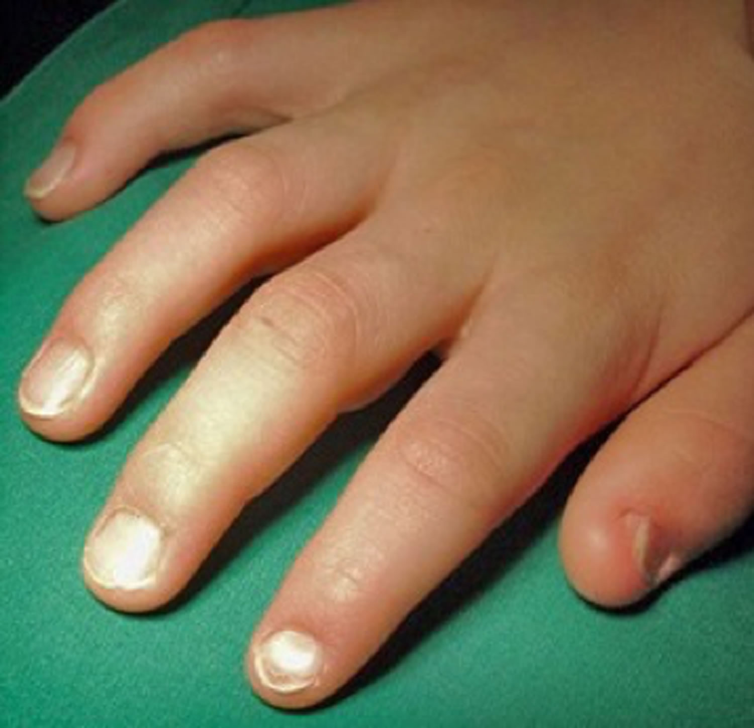 Nail patella syndrome causes, symptoms, diagnosis, treatment & prognosis
