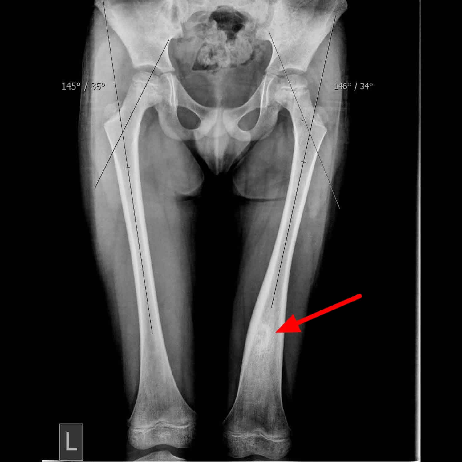 Остеома кости коленного сустава