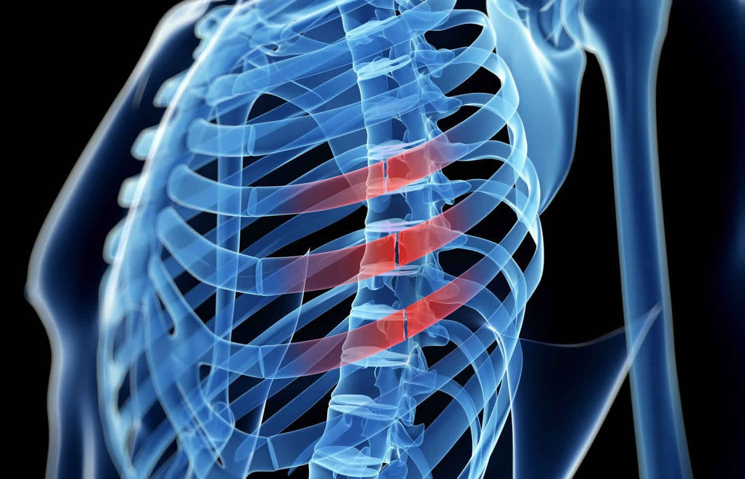 Rib Fracture Causes Symptoms Diagnosis Healing Time Treatment