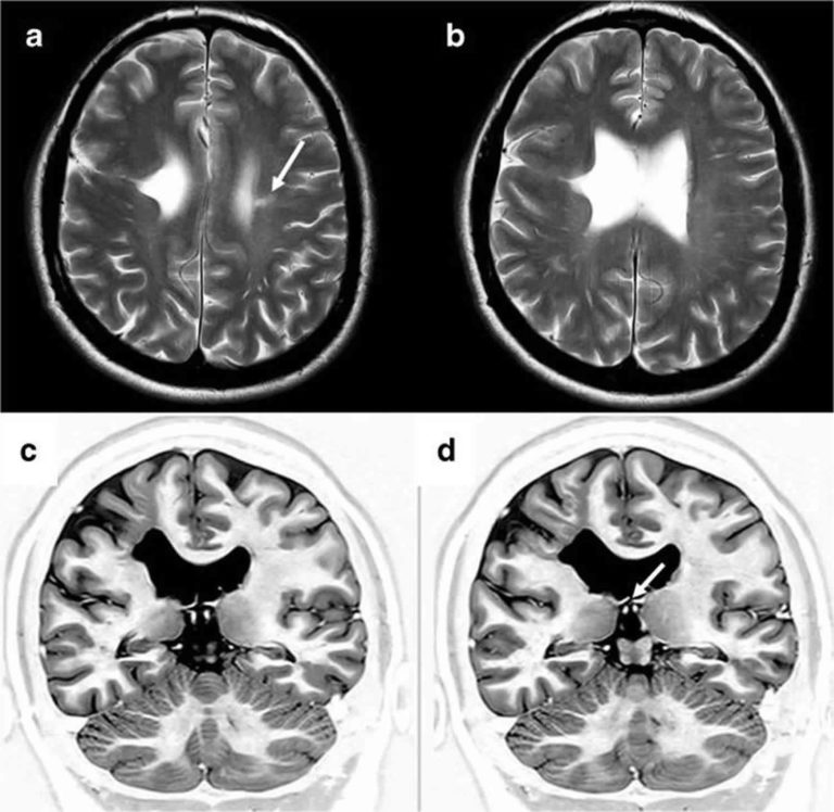 Schizencephaly causes, symptoms, diagnosis, treatment & prognosis