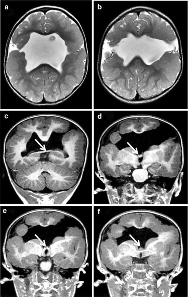 Schizencephaly causes, symptoms, diagnosis, treatment & prognosis