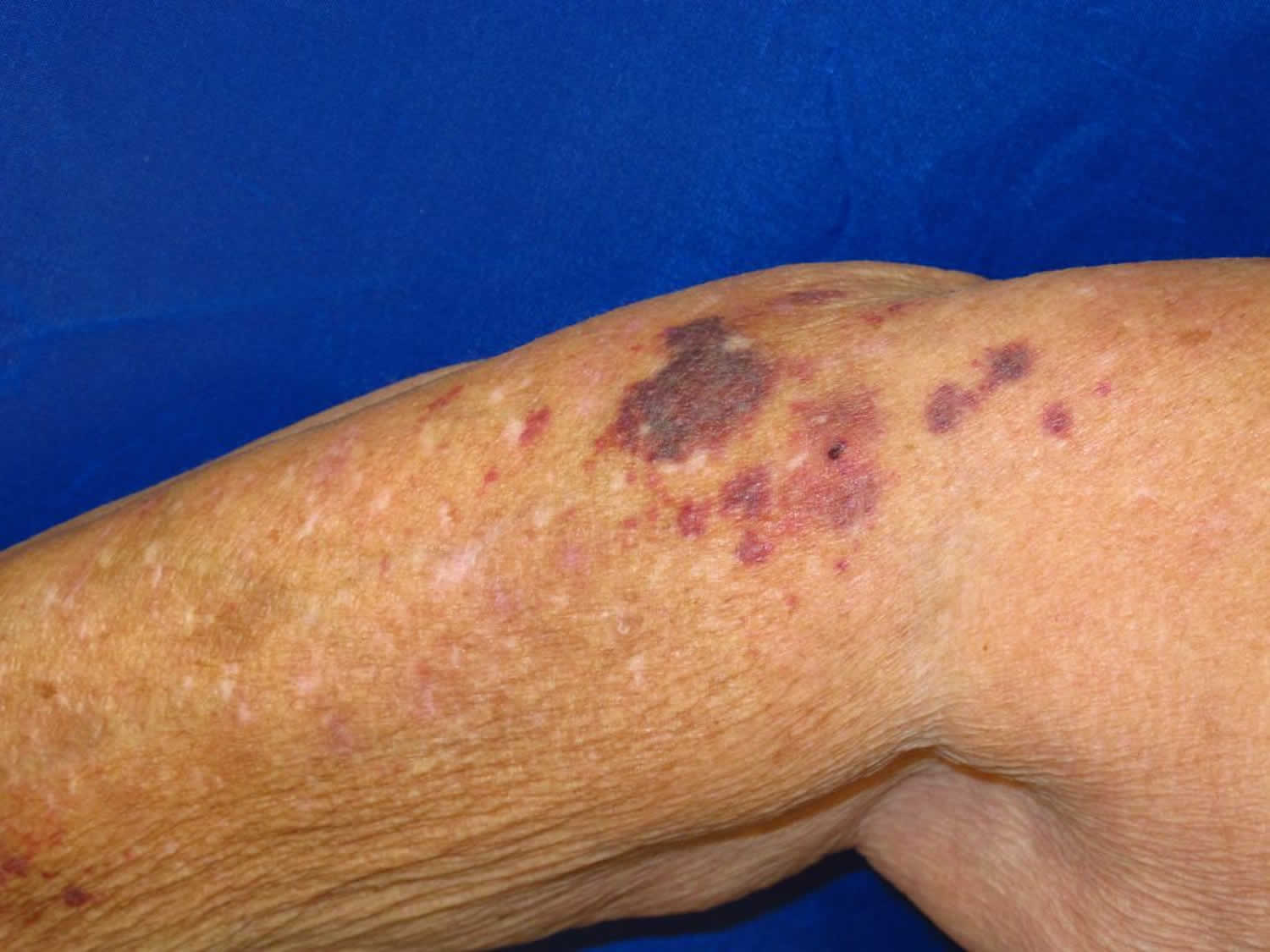 Senile Purpura Causes Symptoms Diagnosis Treatment Prognosis