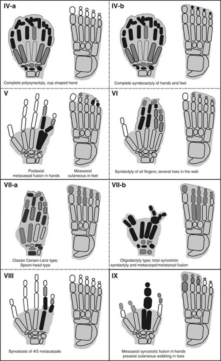 Syndactyly Definition, Causes, Genetics & Syndactyly Treatment