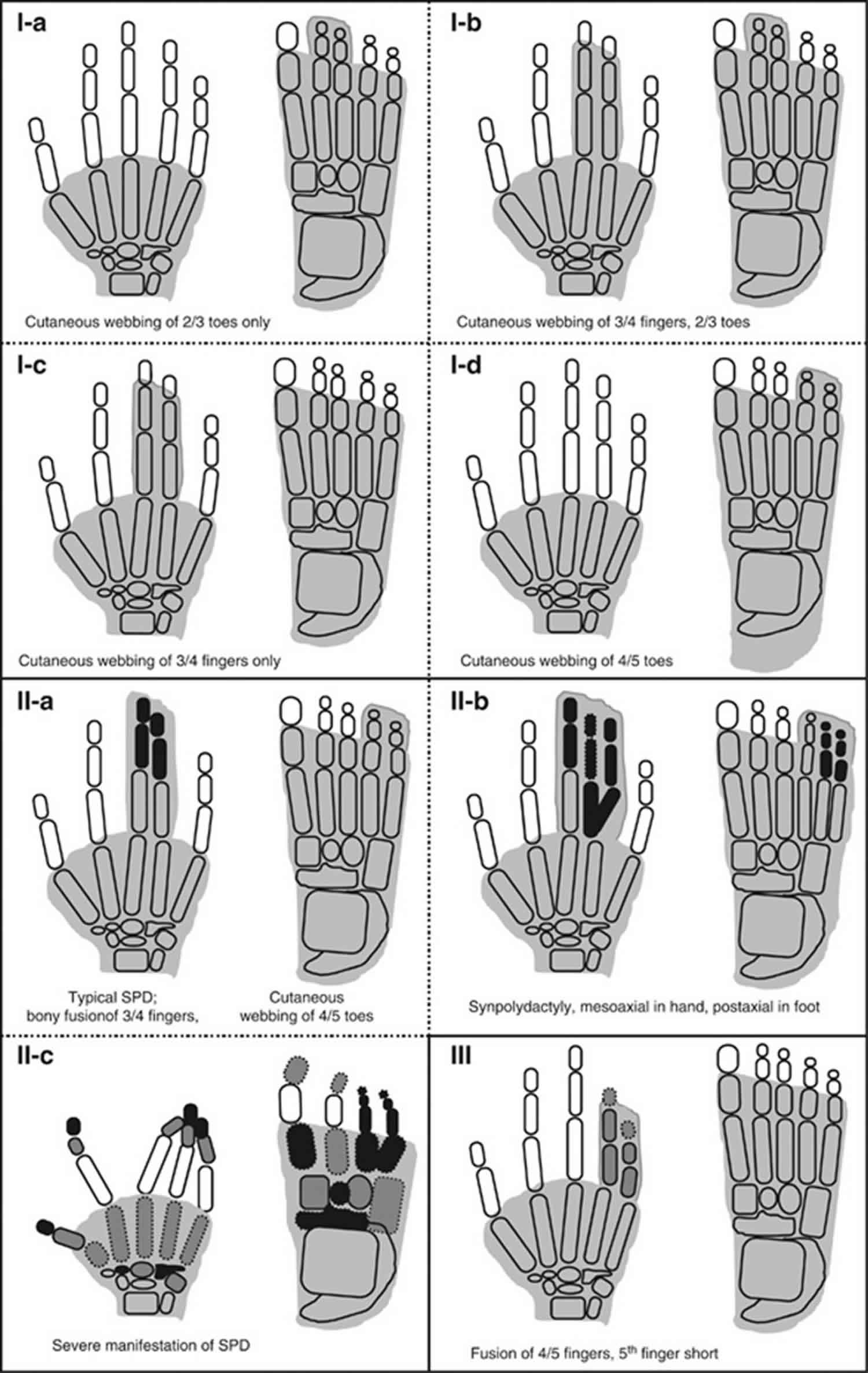 Syndactyly Definition, Causes, Genetics & Syndactyly Treatment