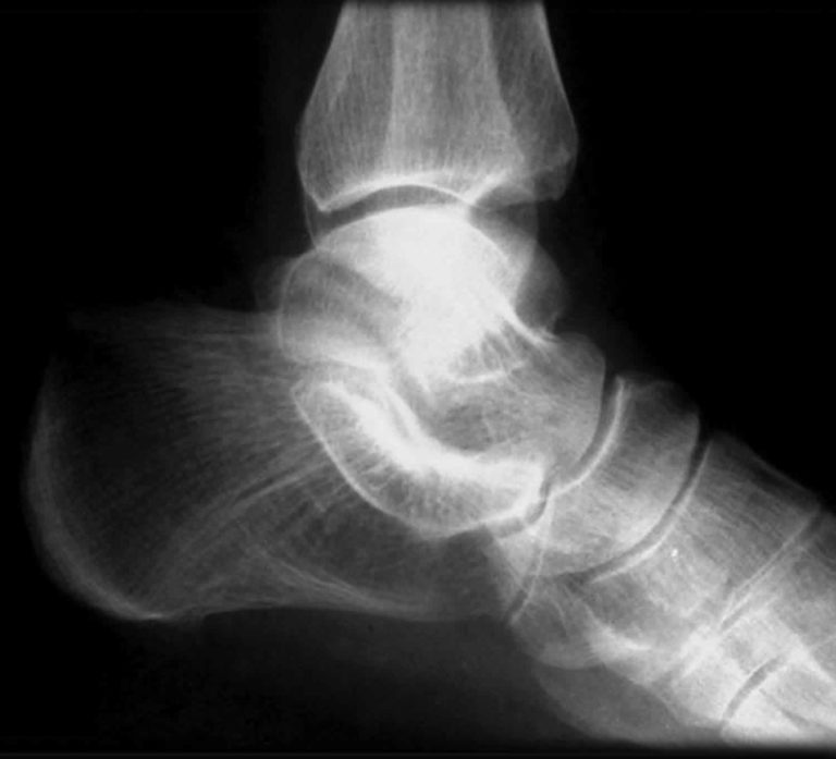 Tarsal coalition causes, symptoms, diagnosis & treatment