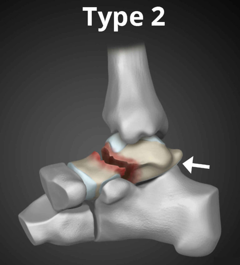 Talus fracture causes, types, symptoms, complications, diagnosis ...