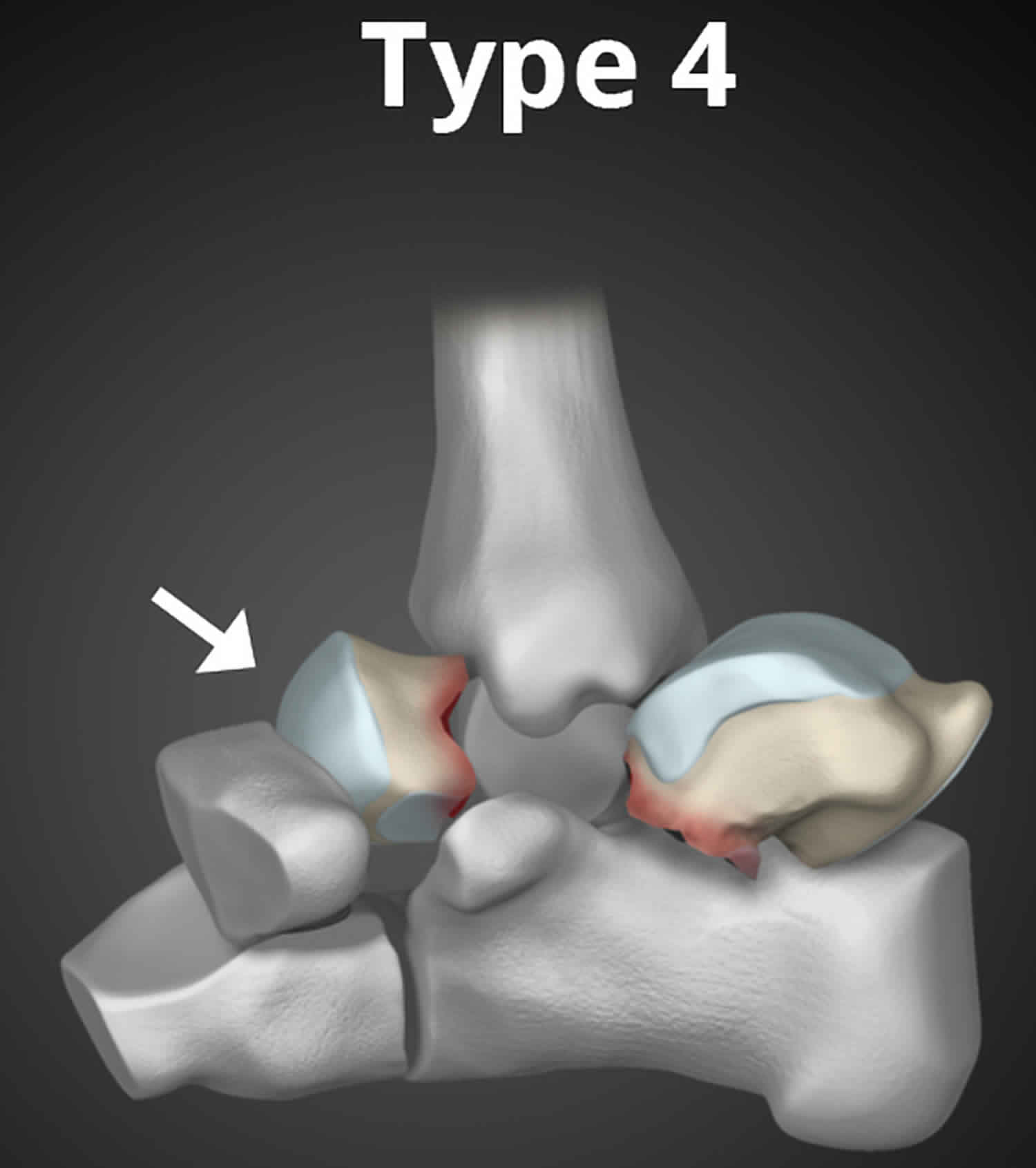 Fracture talus Talus Fracture