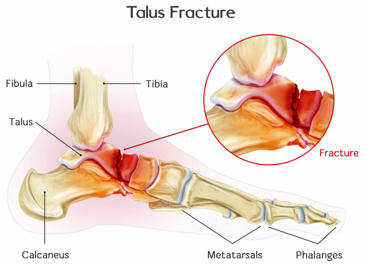 fractura talus structura și tratamentul articulațiilor