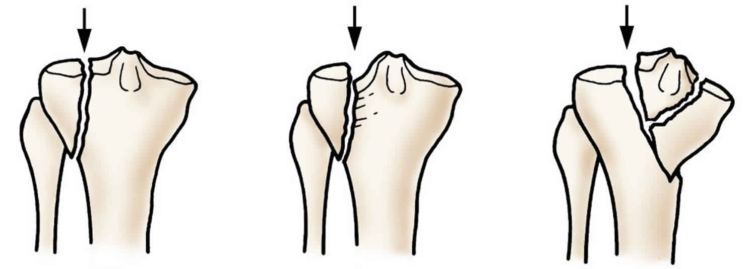 Tibial Plateau Fracture Symptoms Causes Treatment And Rehabilitation Porn Sex Picture