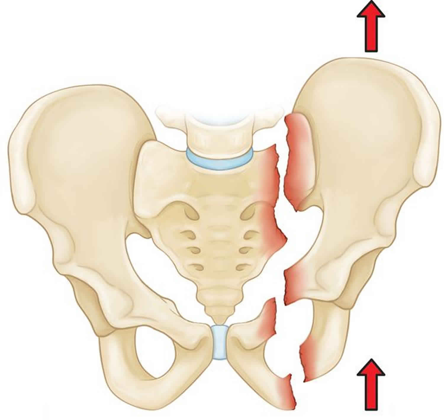 Albums 90+ Images pic of upper and lower pelvic bone break Excellent