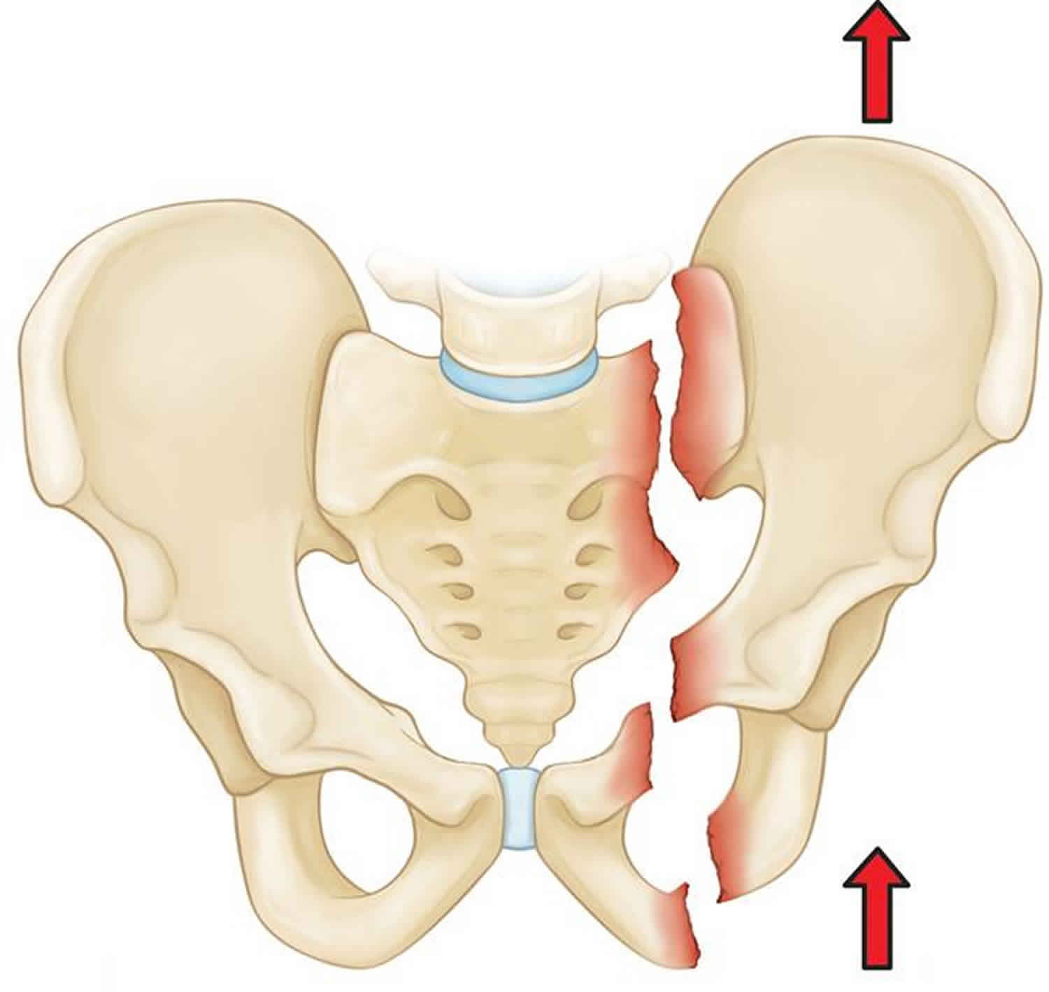 pelvic-fracture-types-causes-signs-symptoms-diagnosis-treatment