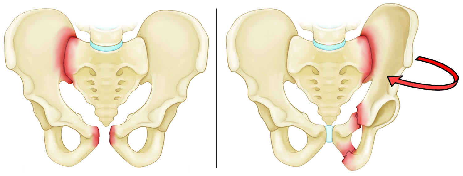 Pelvic fracture types, causes, signs, symptoms, diagnosis & treatment