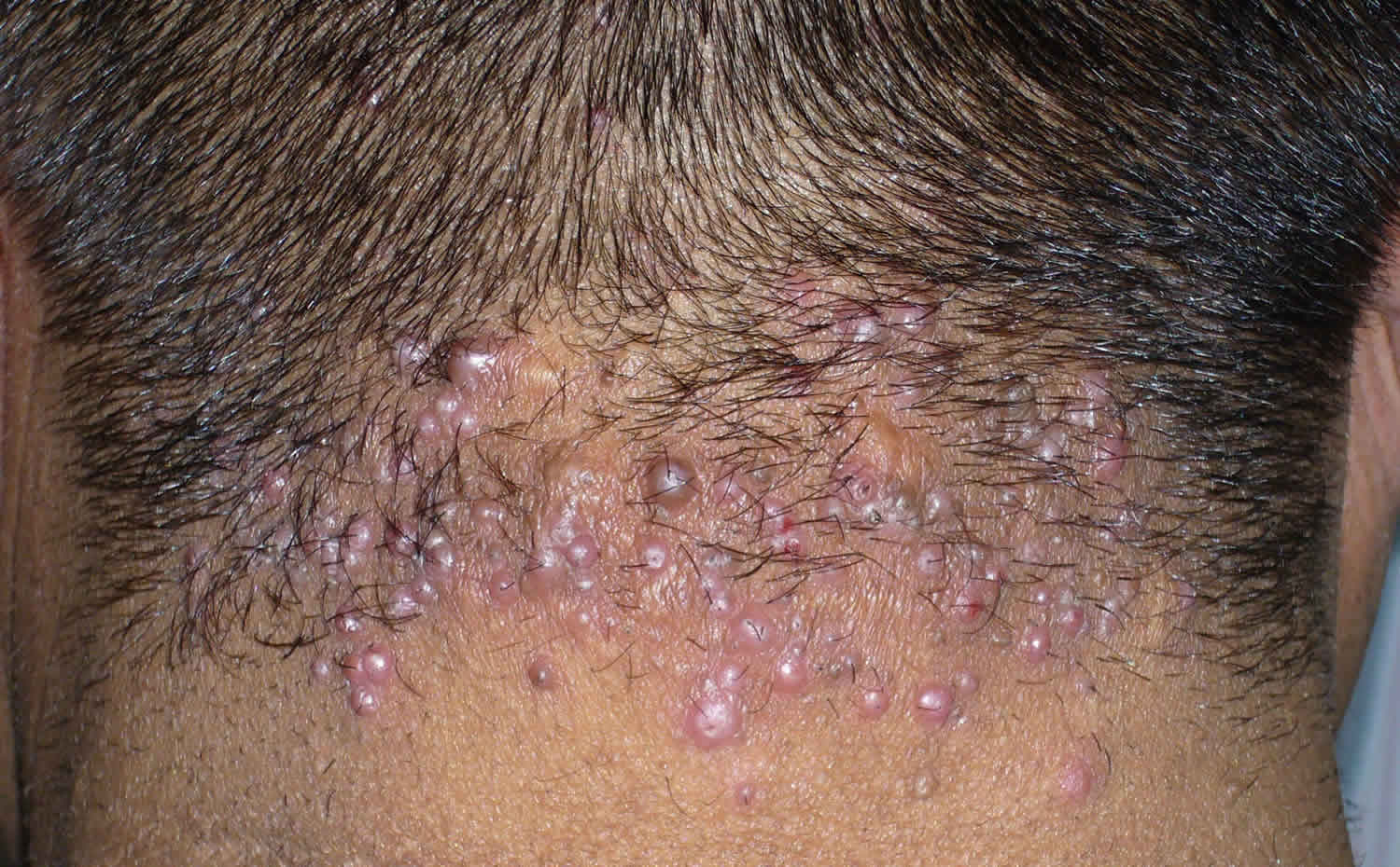 Acne Keloidalis Nuchae Causes Symptoms Diagnosis Treatment