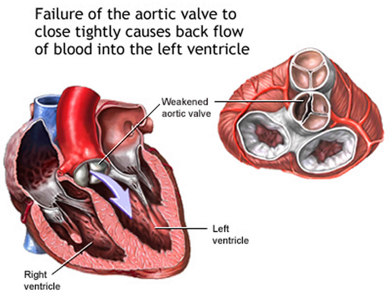 aortic-regurgitation-causes-signs-symptoms-diagnosis-treatment