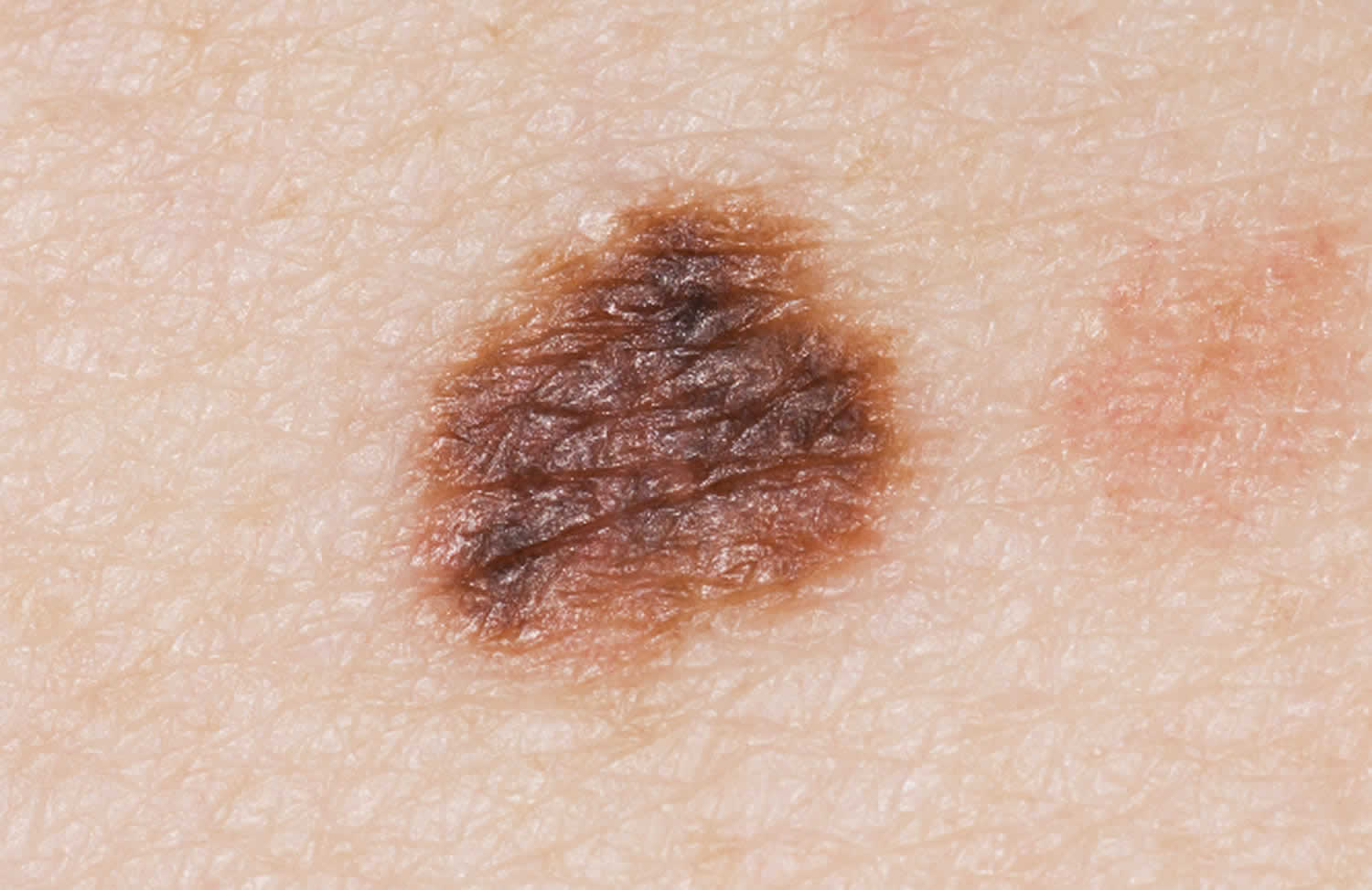 Atypical mole definition, causes, symptoms, diagnosis & treatment