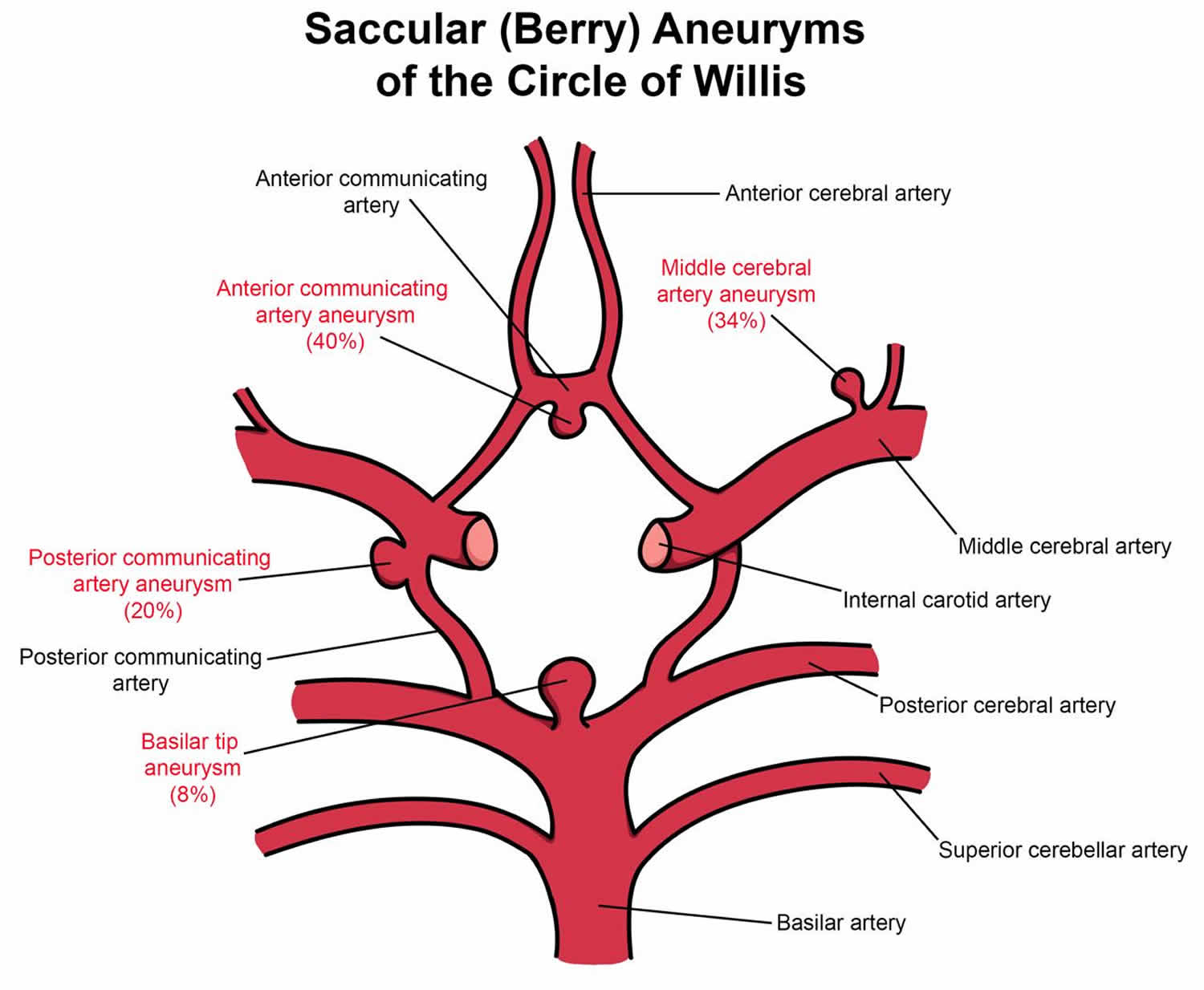 Berry aneurysm causes, signs, symptoms, diagnosis, treatment & prognosis