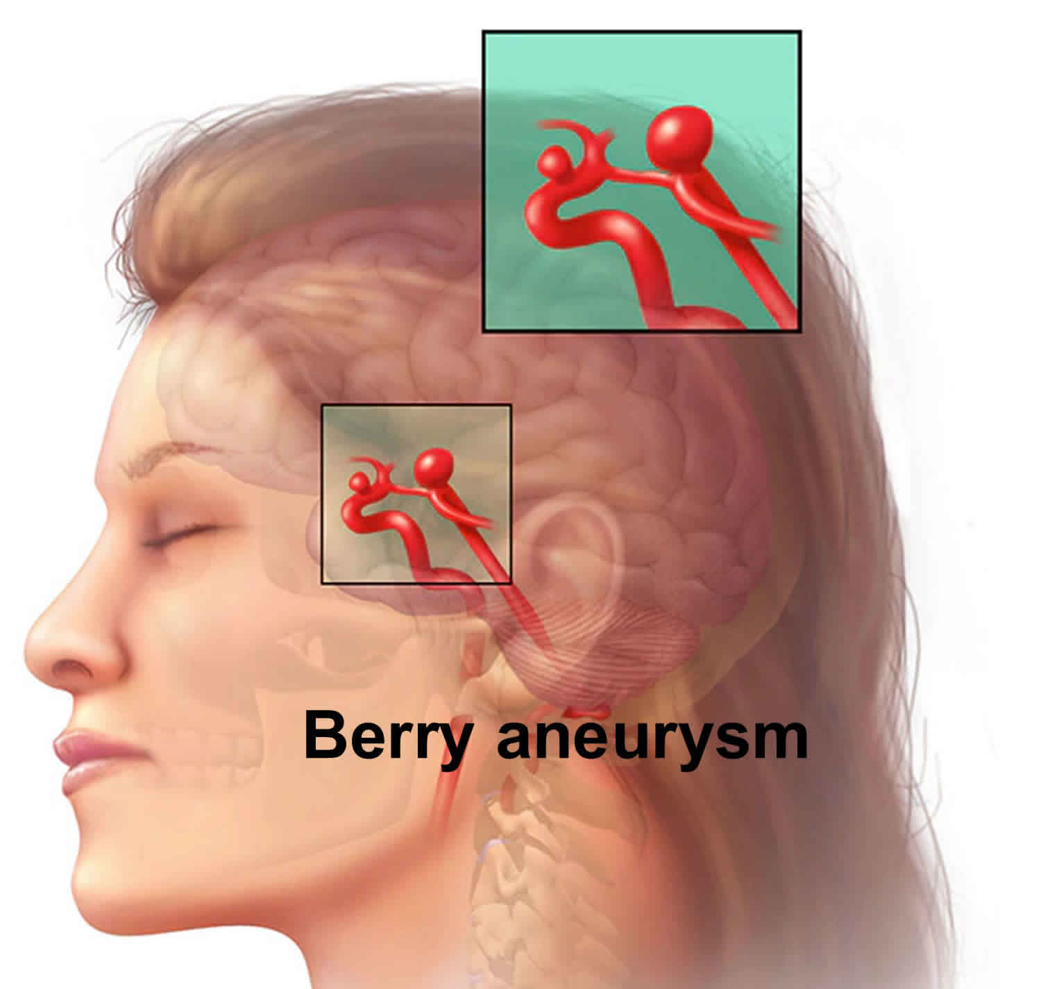 Симптомы разрыва аневризмы. Аневризма сосудов головного мозга. Разрыв аневризма головного мозга. Аневризма сосудов головы. Расслаивающая аневризма головного мозга.