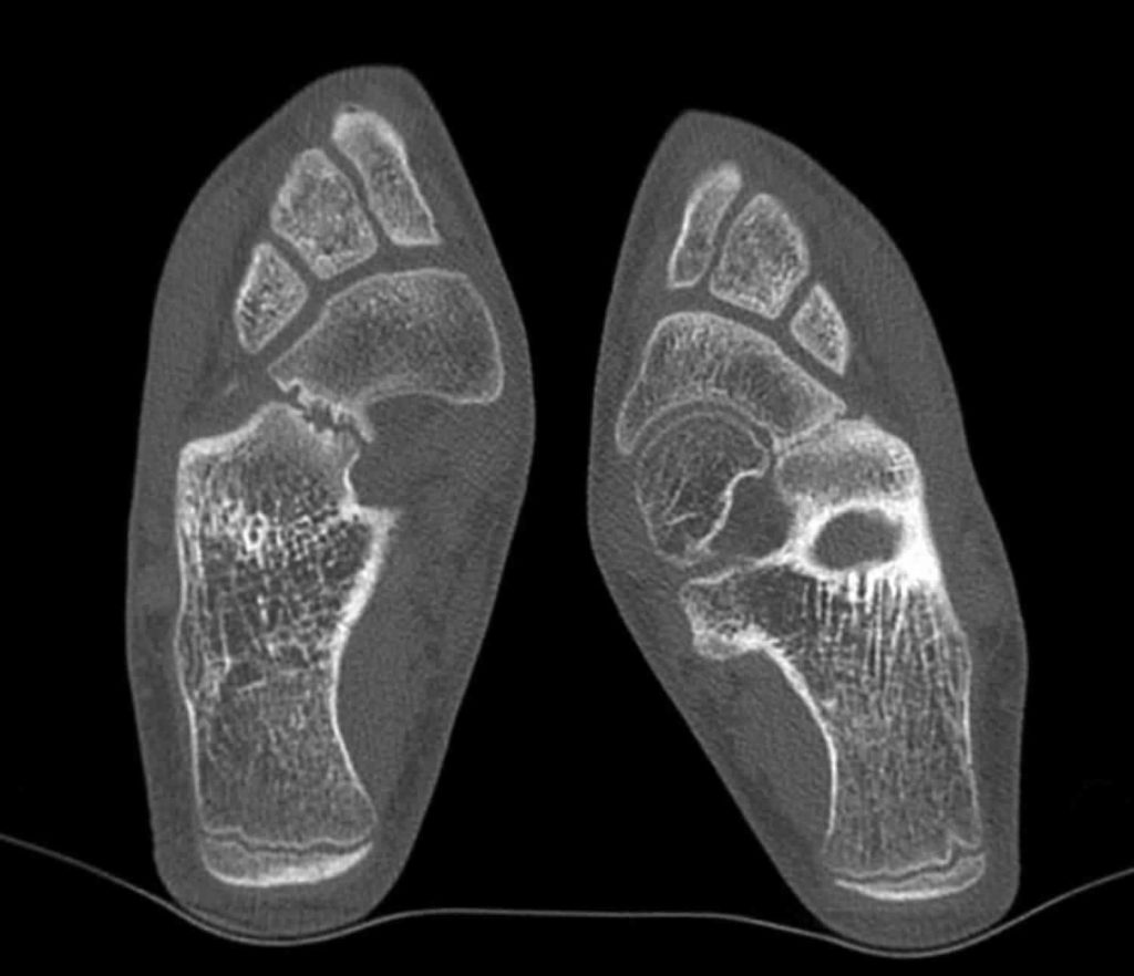 Tarsal Coalition Causes Symptoms Diagnosis And Treatment