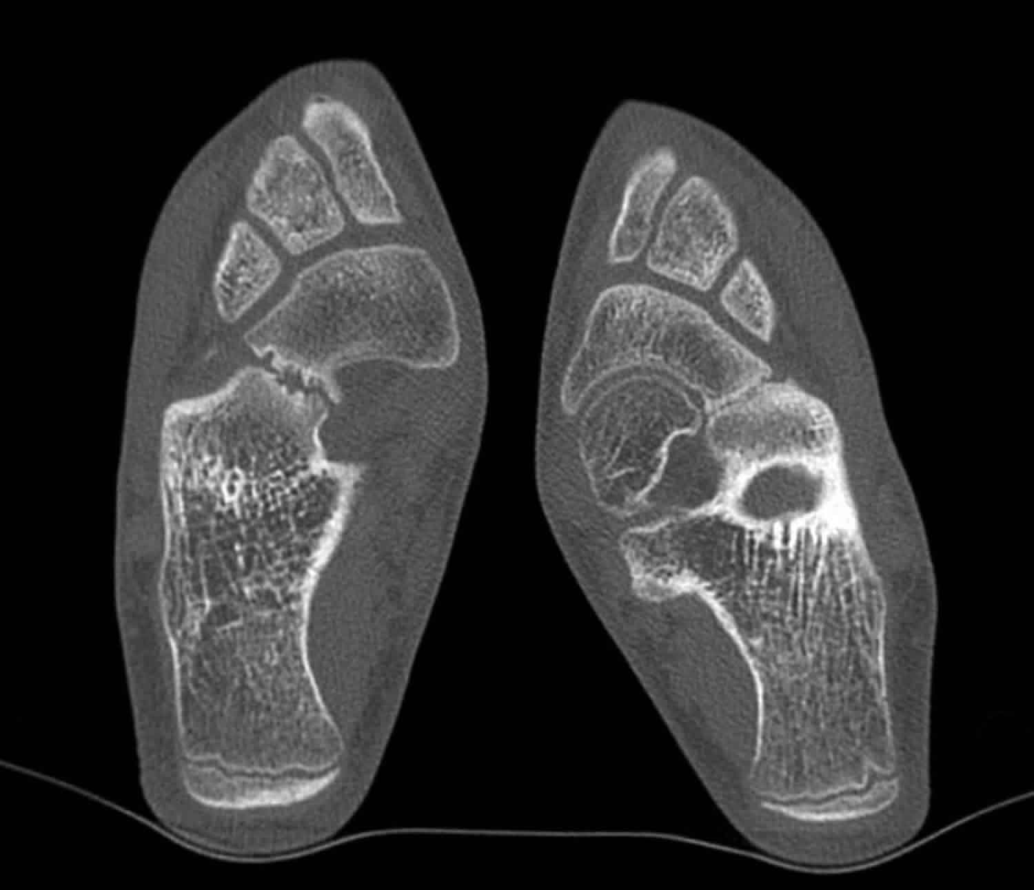 tarsal-coalition-causes-symptoms-diagnosis-treatment