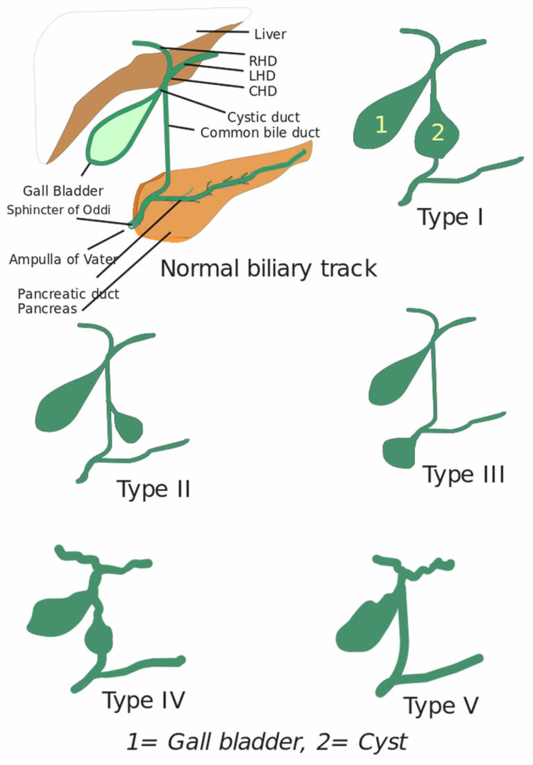 Choledochal cyst types, causes, symptoms, diagnosis & treatment