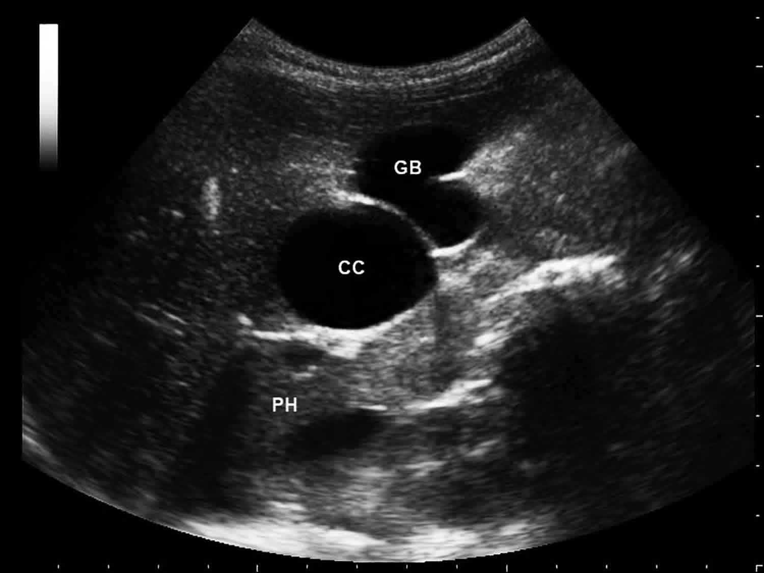 Gallbladder Wall Cyst Ultrasound