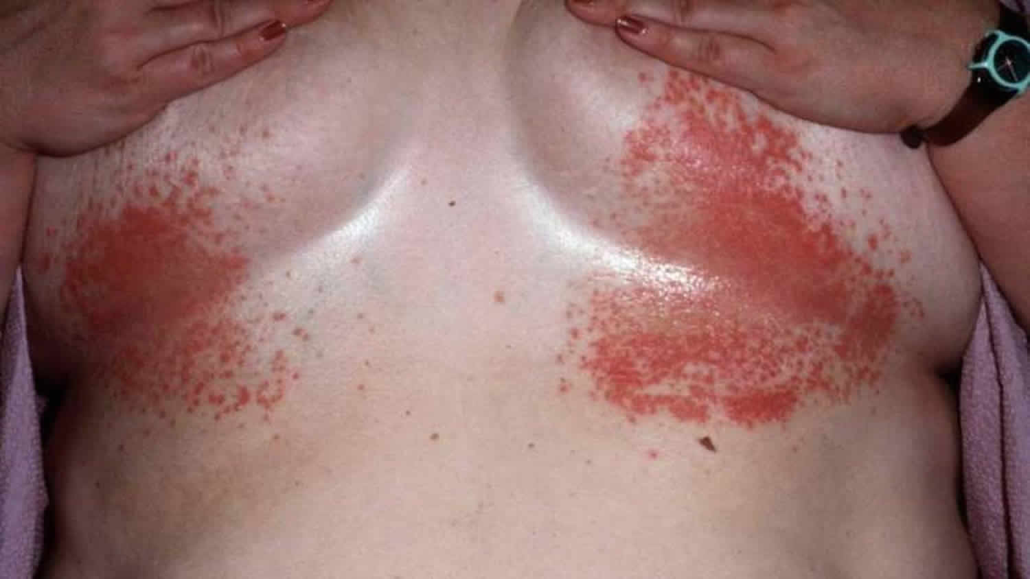 candidiasis of skin