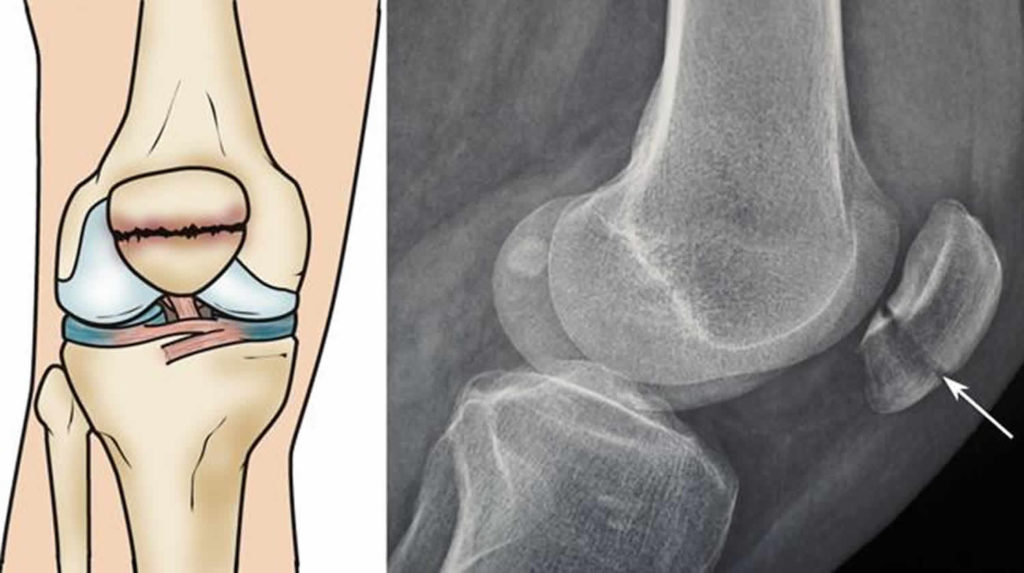 Patella fracture causes, types, symptoms, diagnosis, treatment & recovery