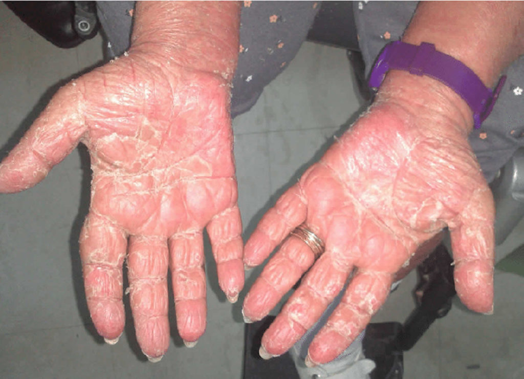 Exfoliative dermatitis causes, prevention, symptoms, diagnosis & treatment