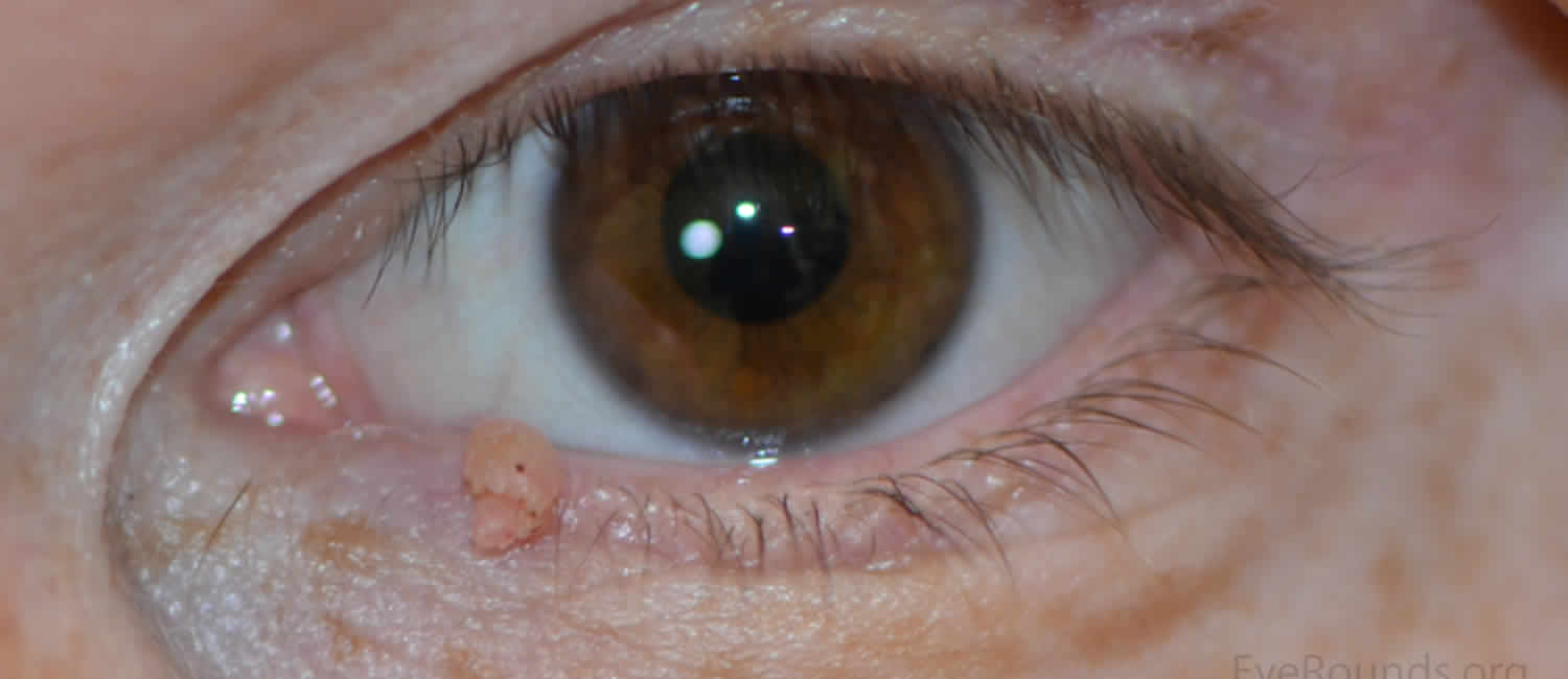 papilloma eyelid