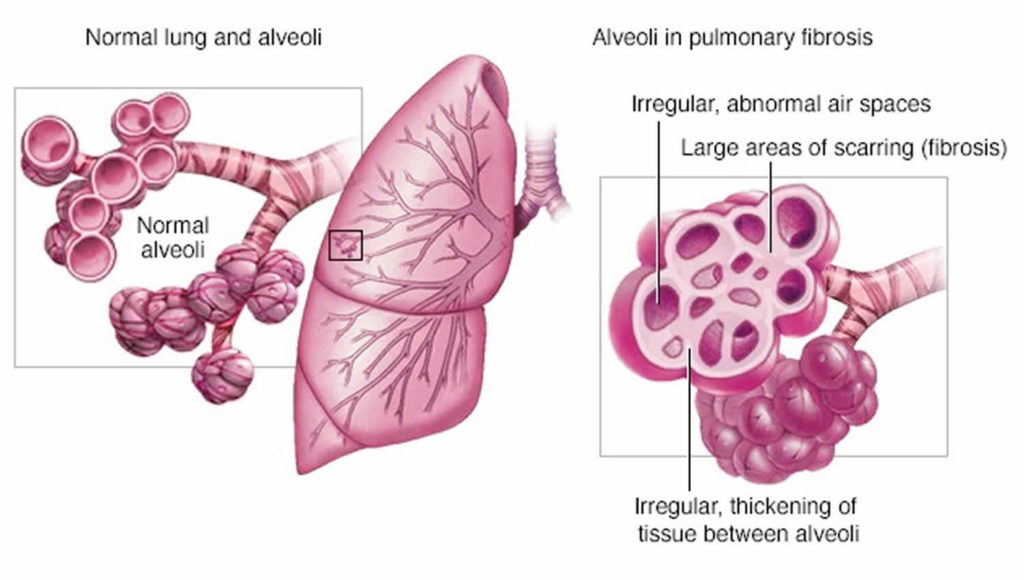 farmer-s-lung-causes-symptoms-diagnosis-treatment-prognosis