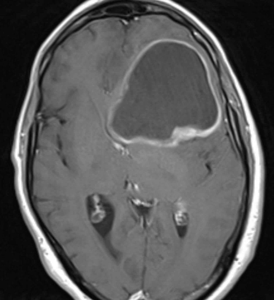 Glioblastoma multiforme causes, signs, symptoms, diagnosis & treatment