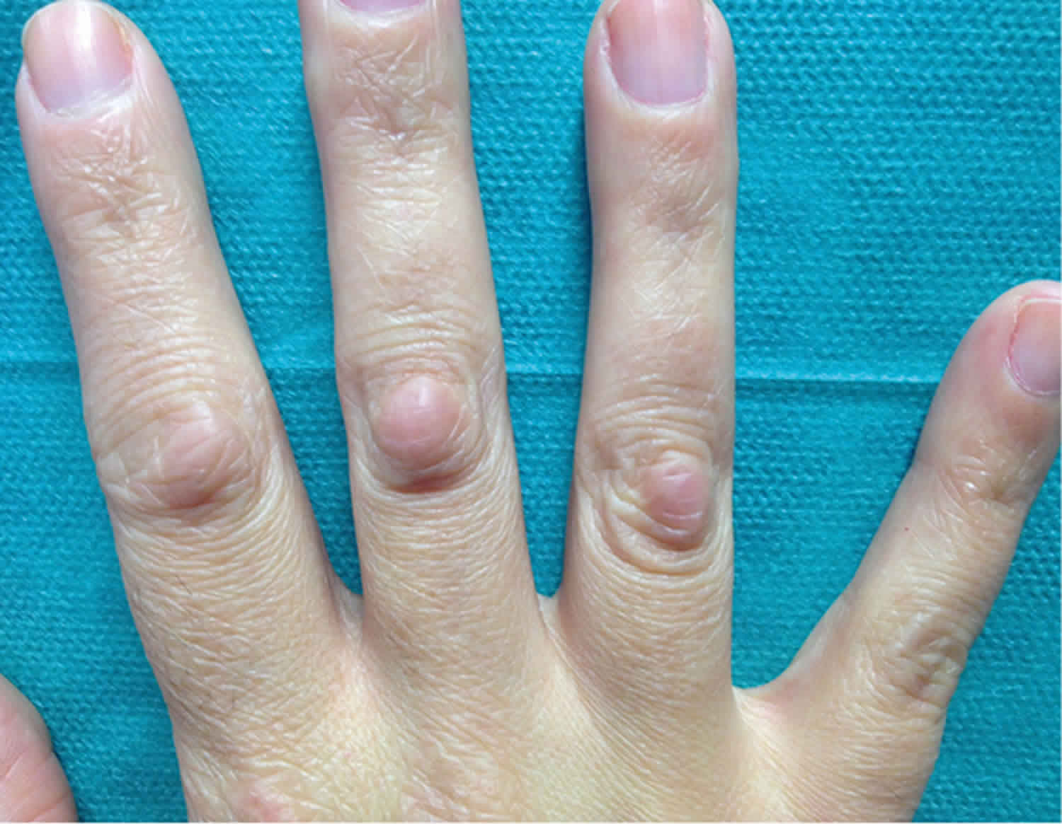 Red Sore Bumps On Finger Joints