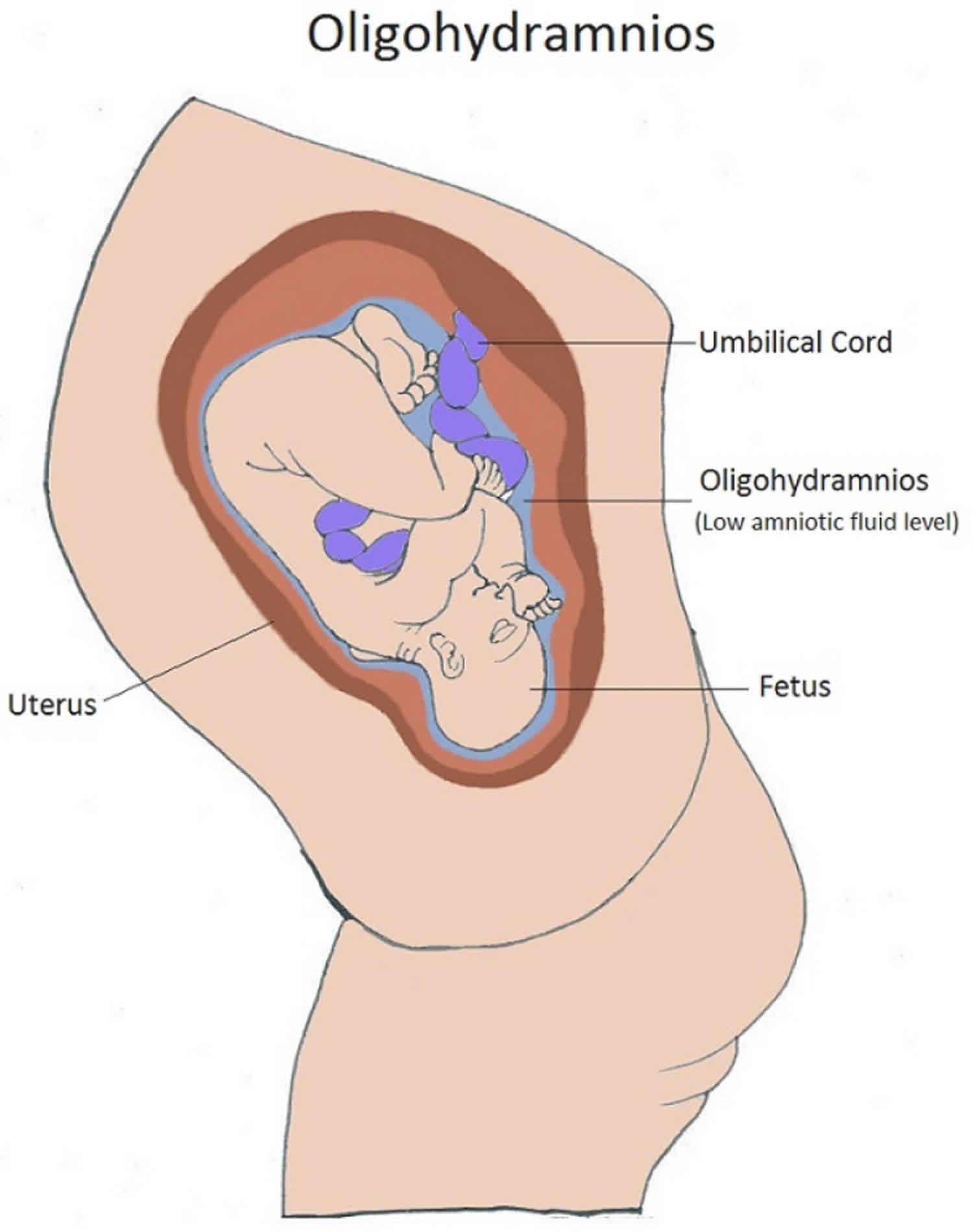 Amniotic Fluid Index