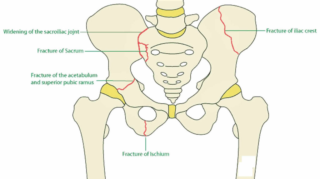 bone fracture pelvic