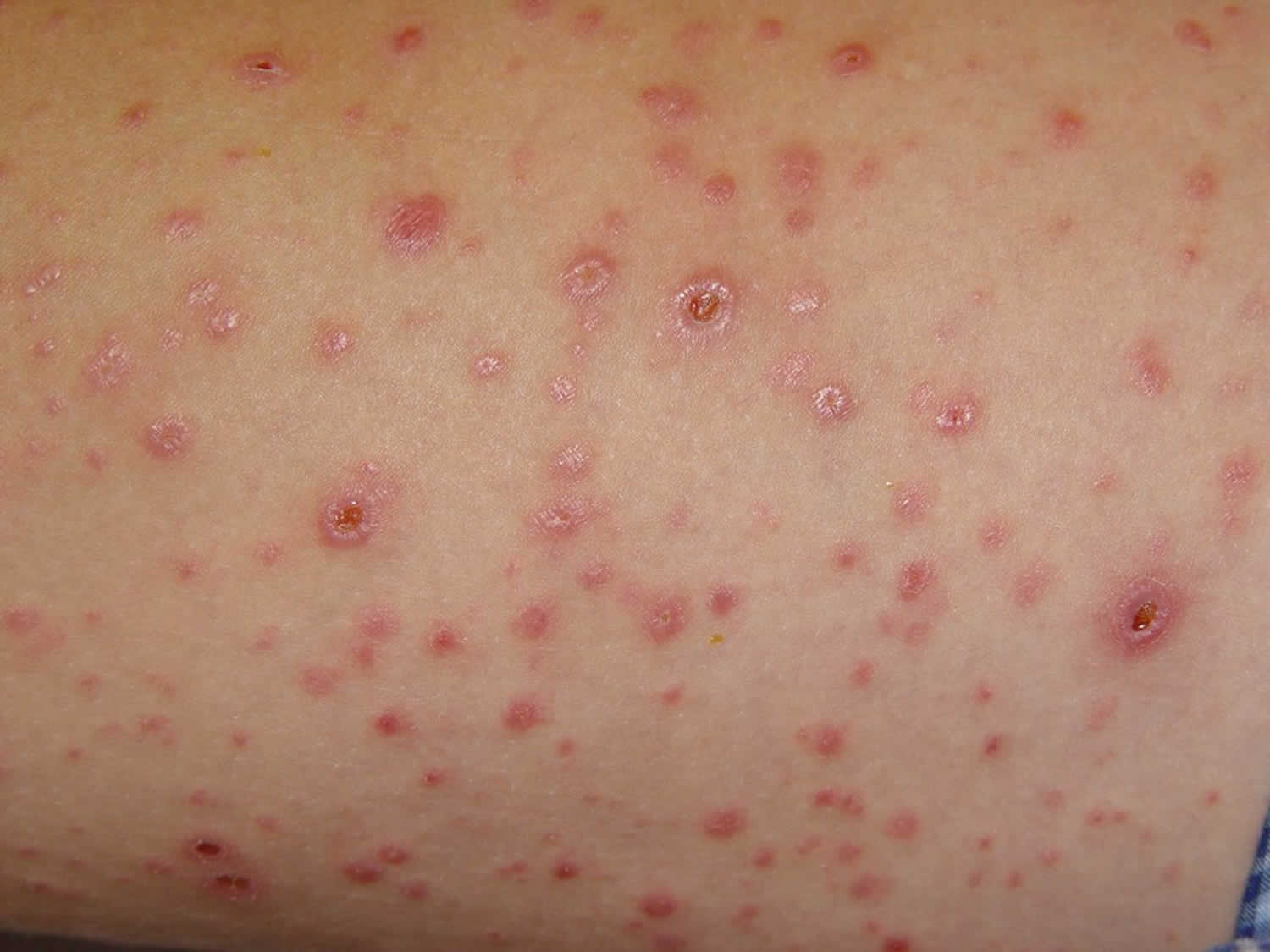 pityriasis-lichenoides-causes-symptoms-diagnosis-treatment-prognosis