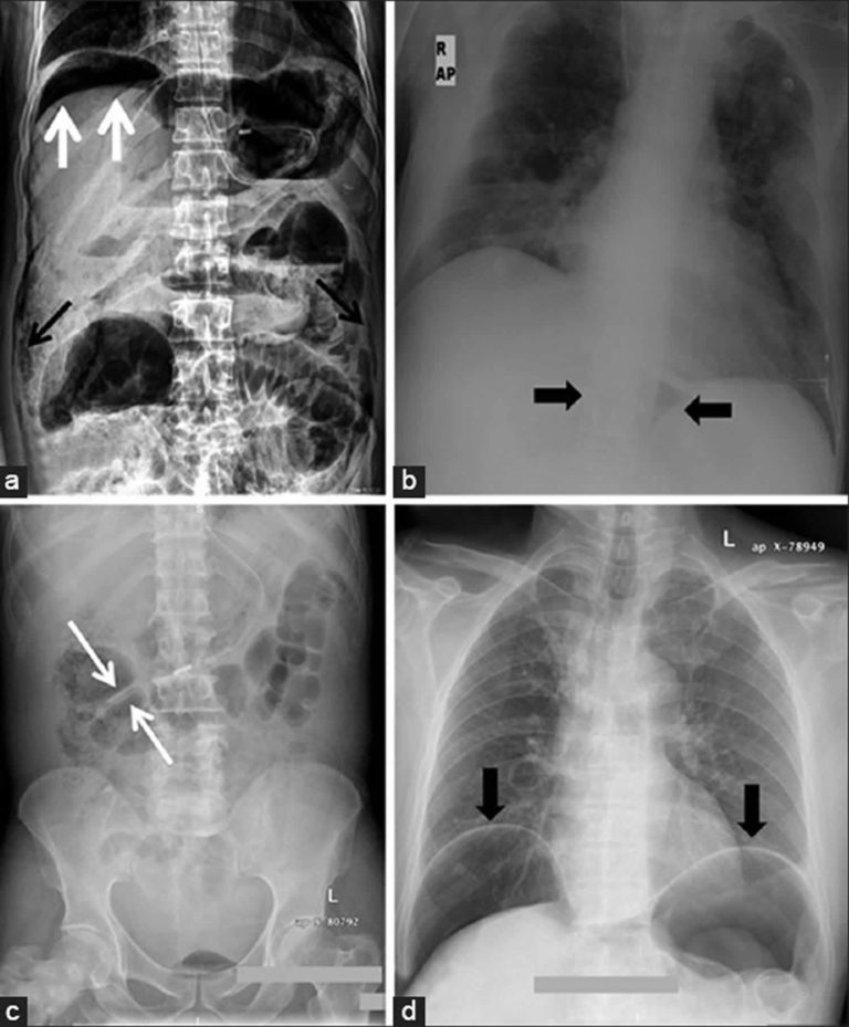 Pneumoperitoneum definition, causes, symptoms, diagnosis & treatment