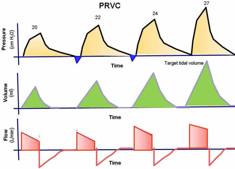 Mechanical ventilation types, indications, complications, settings & modes