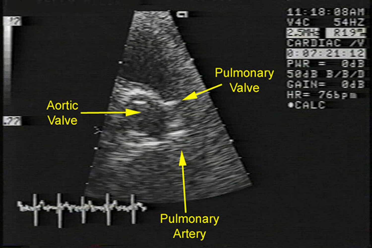 Pulmonic Stenosis Causes Types Symptoms Diagnosis And Treatment 9235