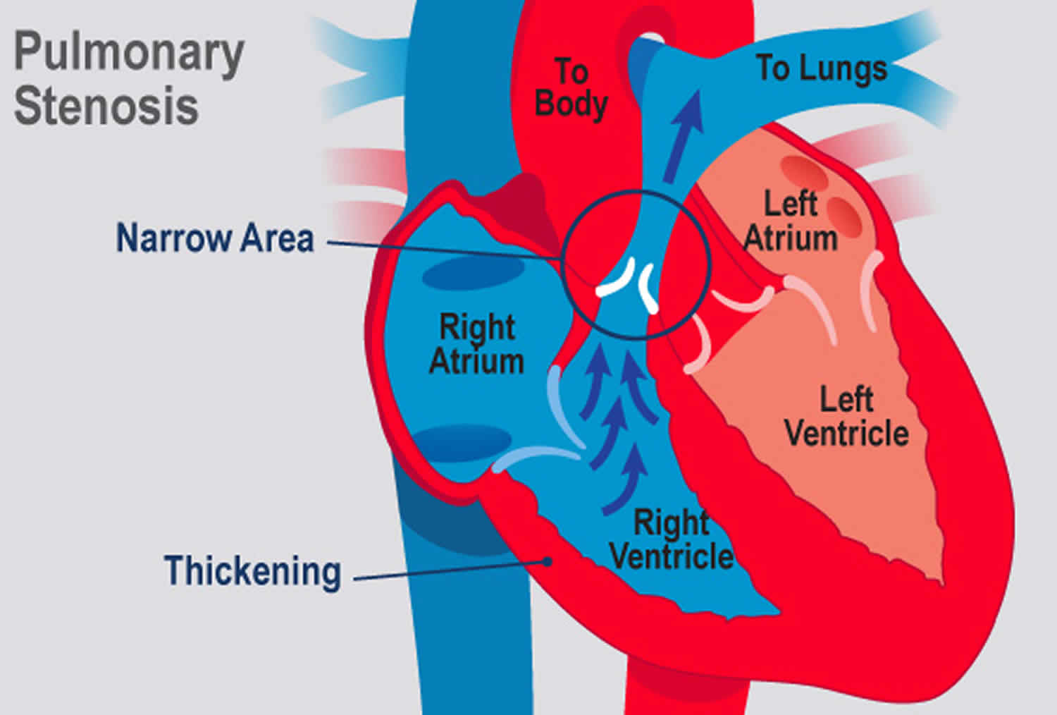 Pulmonic Stenosis Grading