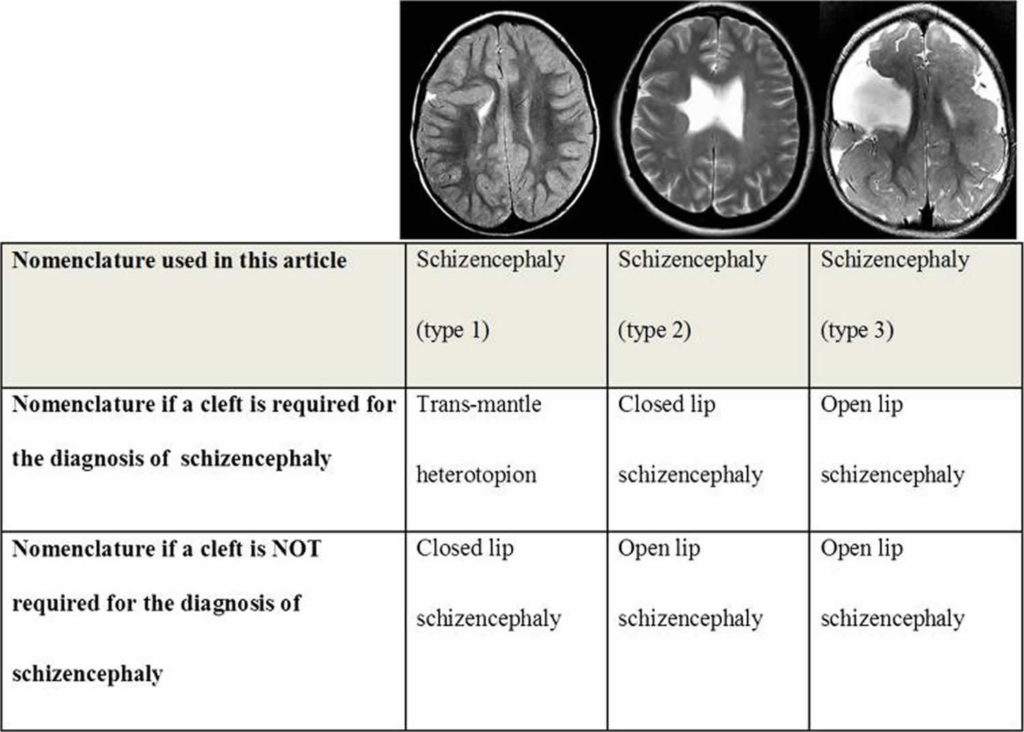 Schizencephaly causes, symptoms, diagnosis, treatment & prognosis