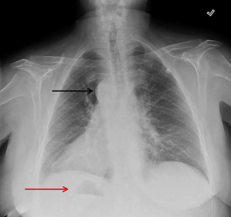 Situs Inversus Definition Causes Symptoms Diagnosis And Treatment