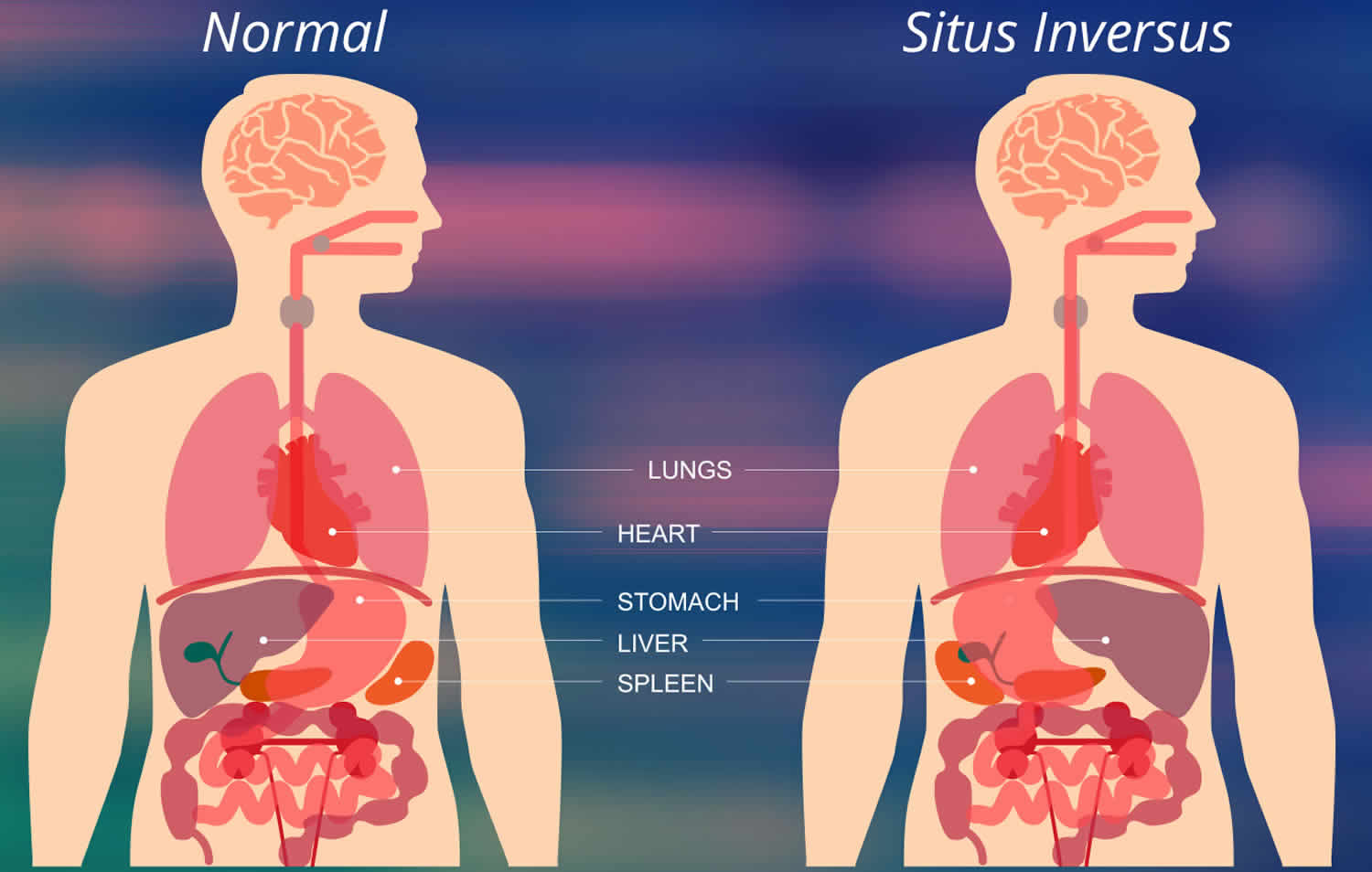 Situs inversus definition, causes, symptoms, diagnosis &amp; treatment